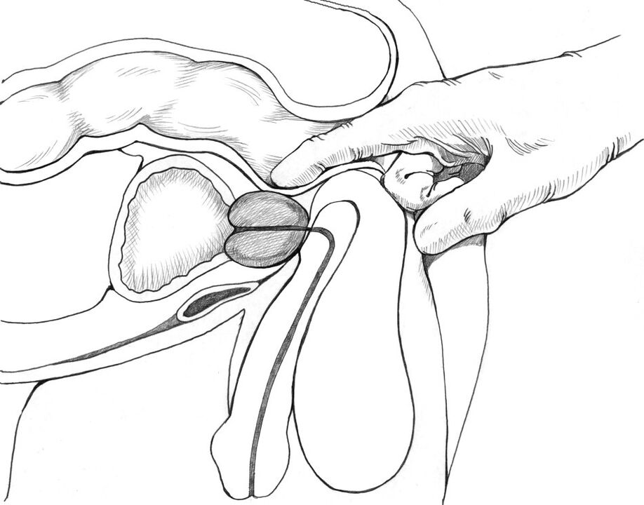 Ang masahe sa prostate ay kasama sa kumplikadong mga pamamaraan ng paggamot sa prostatitis