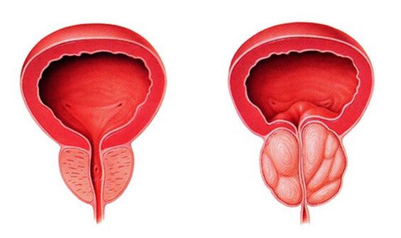Normal at inflamed prostate (prostatitis)